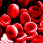 anemia